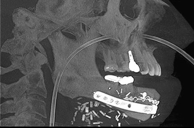 VSP for Patient-Specific Reconstructive Microsurgery Case Study Figure 5b