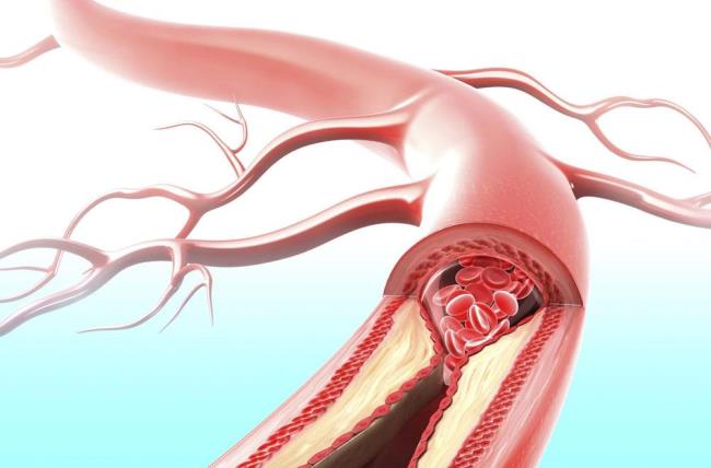 Coronary heart disease