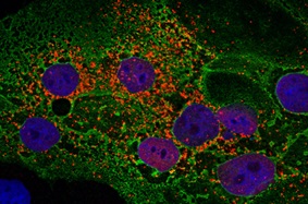 Coronavirus infected cells under microscope 