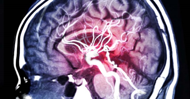 MRI_Of_Brain_Scan