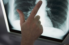 Physician looking at a scan of lungs