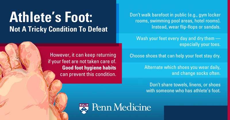 infographic_explains_athletes_foot_is_easy_to_treat_offers_prevention_tips_picture_of_foot