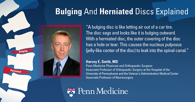 herniated disc 