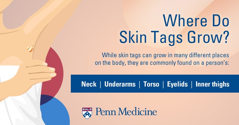 infographic_shows_skin_tags_under_arms_explains_skin_tags_grow_on_neck_underarms_torso_eyelids_inner_thighs