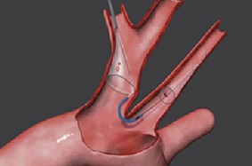 Illustration of Sentinel device by Claret Medical