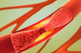 illustration of a blocked artery