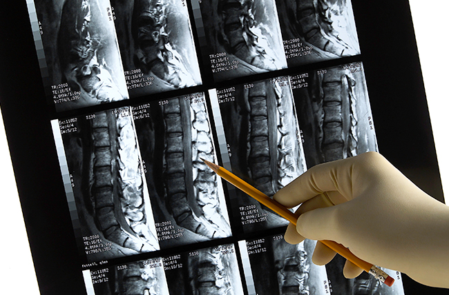 scoliosis xray