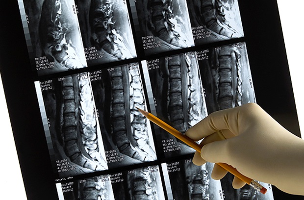 scoliosis xray