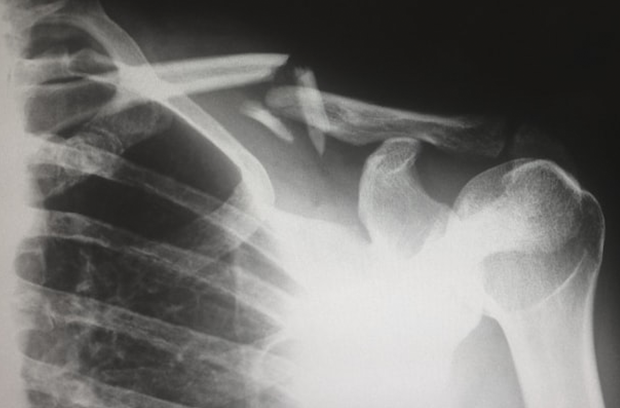 skeleton shoulder