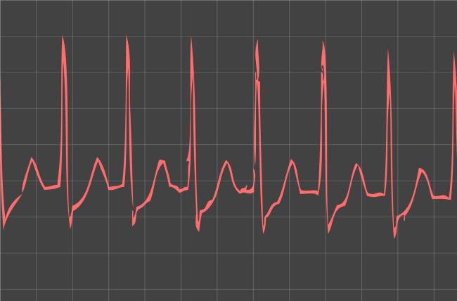 ECG displaying supraventricular tachycardia