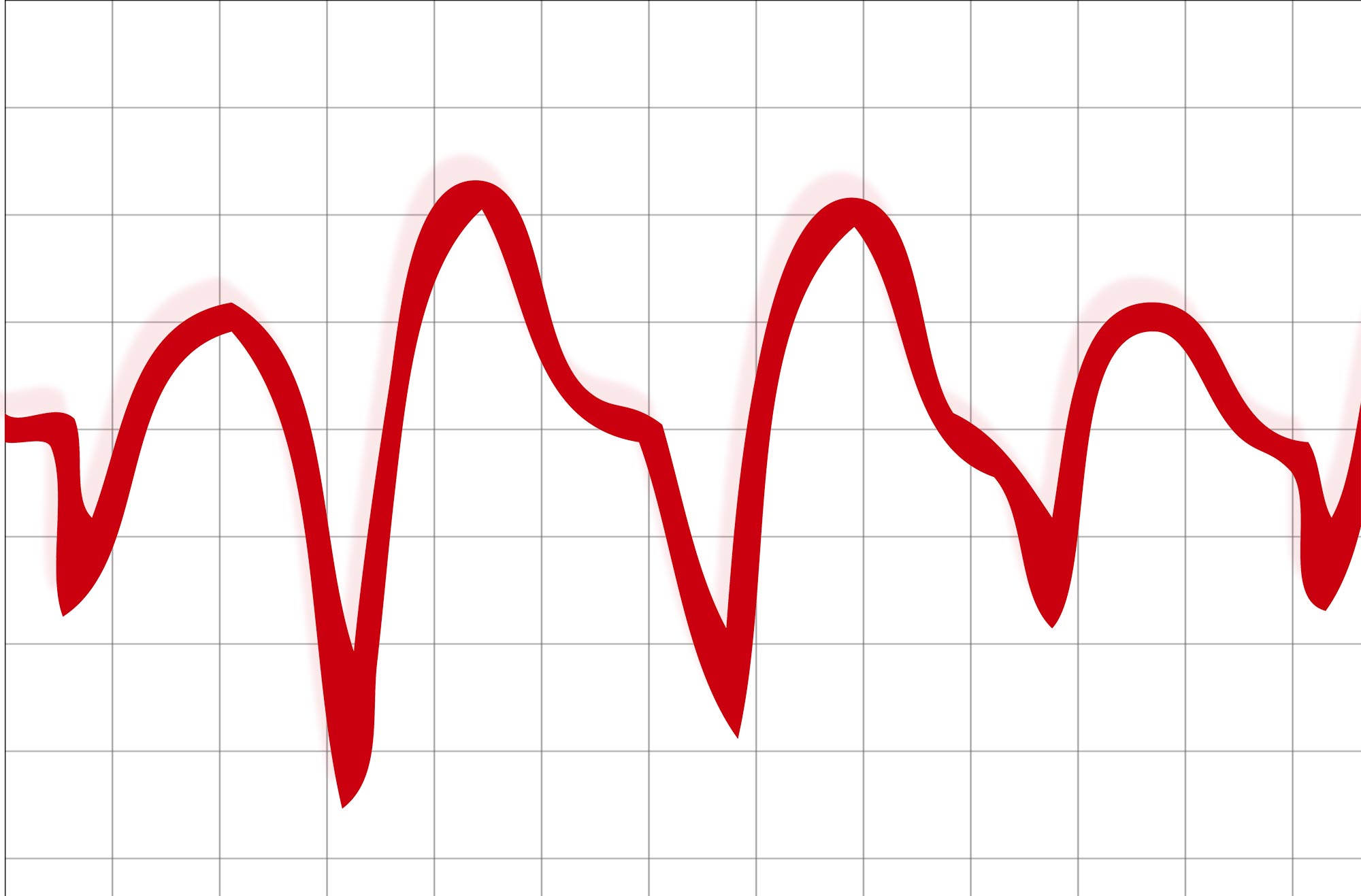Illustration of ventricular tachycardia ECG