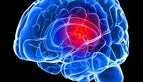 Brain tumor